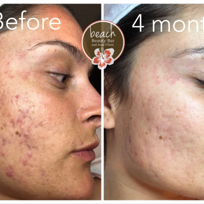 Clear Acne Scarring